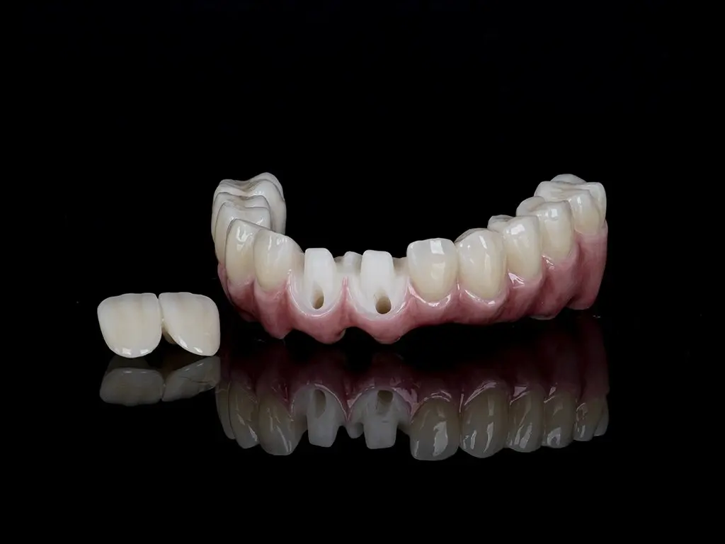 Zirconia bridge lower jaw